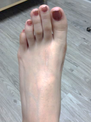 Bunion Correction