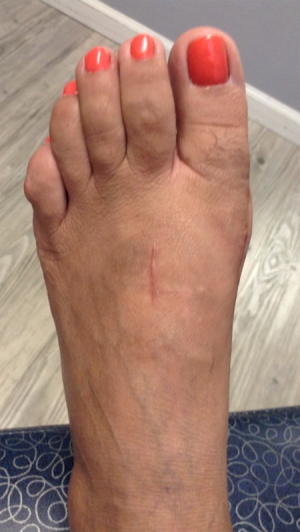 Bunion Correction