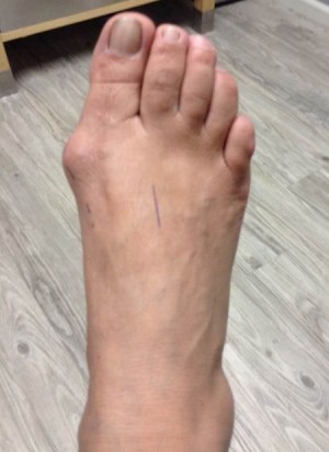 Bunion Correction