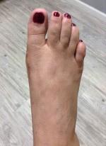 Bunion Correction