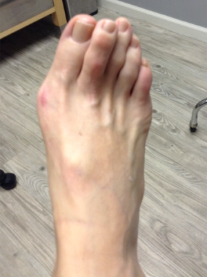 Bunion Correction