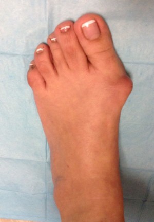 Bunion Correction