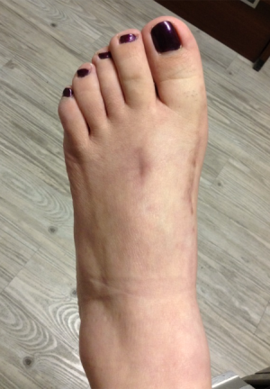 Bunion Correction