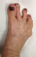 Hallux Varus Correction