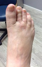 Hallux Varus Correction