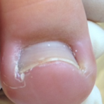 Chronic Ingrown Toenail Permanent Correction