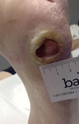 Diabetic Foot Ulcer