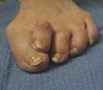 Bunion Correction