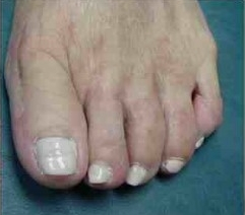 Bunion Correction