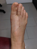 Bunion Correction