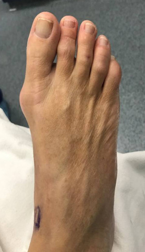 Bunion Correction