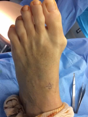 Bunion Correction