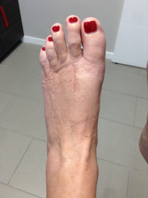 Bunion Correction