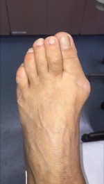 Bunion Correction