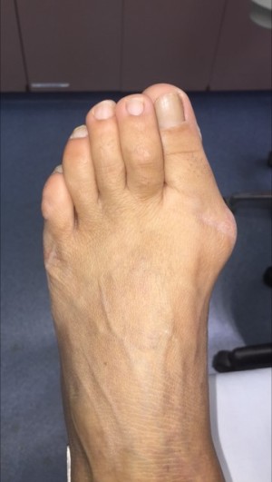 Bunion Correction