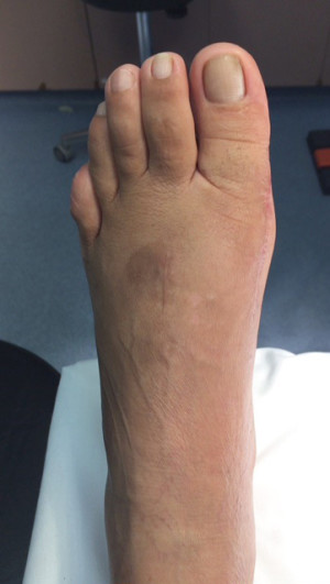 Bunion Correction