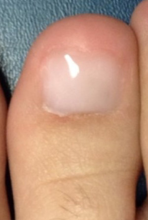 KeryFlex Nail Restoration