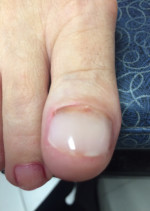 KeryFlex Nail Restoration