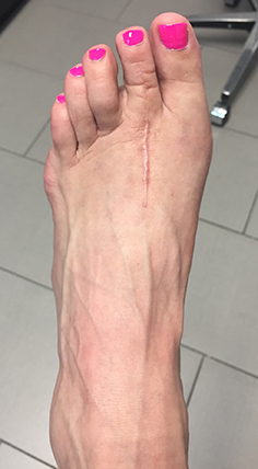 Bunion Correction