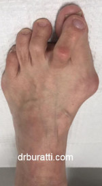 Bunion Correction