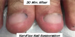 KeryFlex Nail Restoration