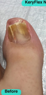 KeryFlex Nail Restoration