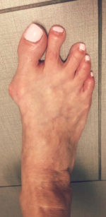 Bunion Correction