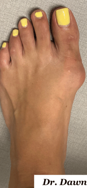 Bunion Correction