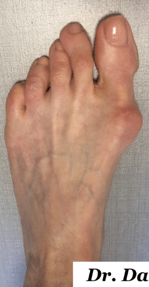 Bunion Correction