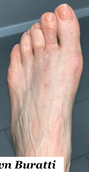 Bunion Correction