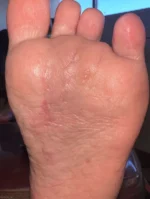 Fat Pad Augmentation