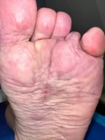 Fat Pad Augmentation