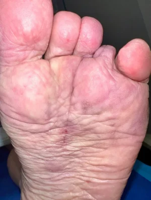 Fat Pad Augmentation