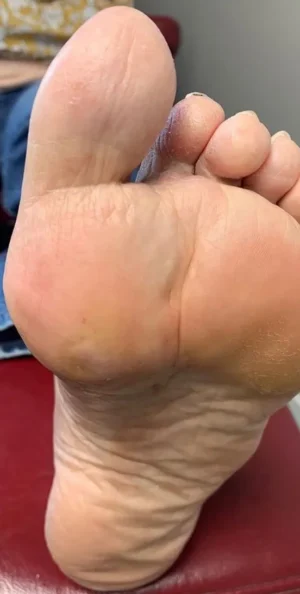 Fat Pad Augmentation