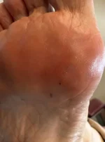 Fat Pad Augmentation