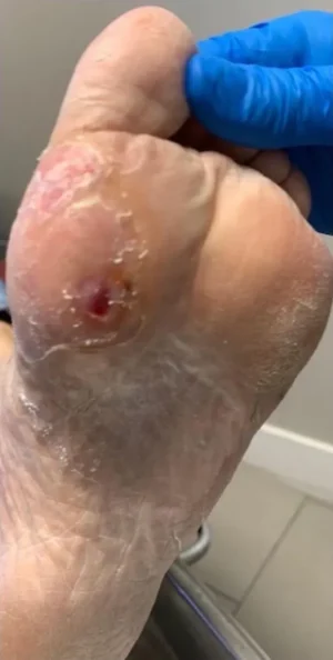 Fat Pad Augmentation