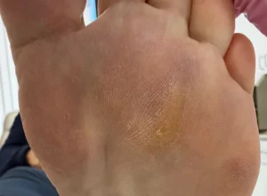 Fat Pad Augmentation