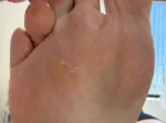 Fat Pad Augmentation