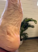 Fat Pad Augmentation