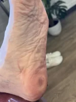 Fat Pad Augmentation