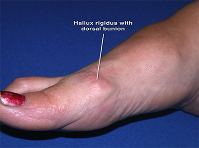 hallux rigidus encino