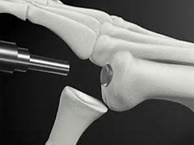 hallux rigidus encino