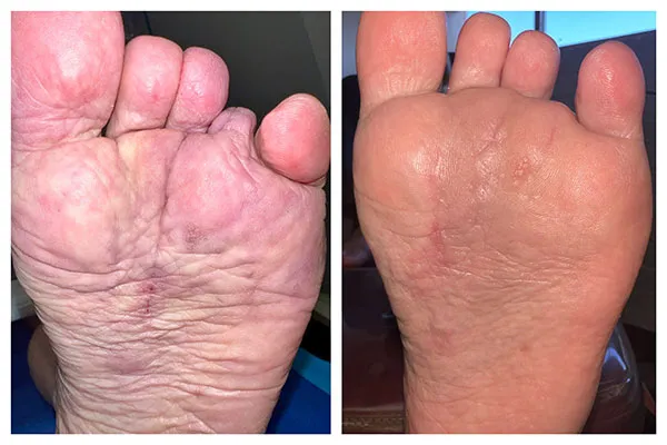 before and after fat pad augmentation