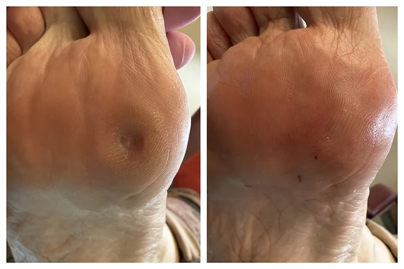 before and after fat pad augmentation