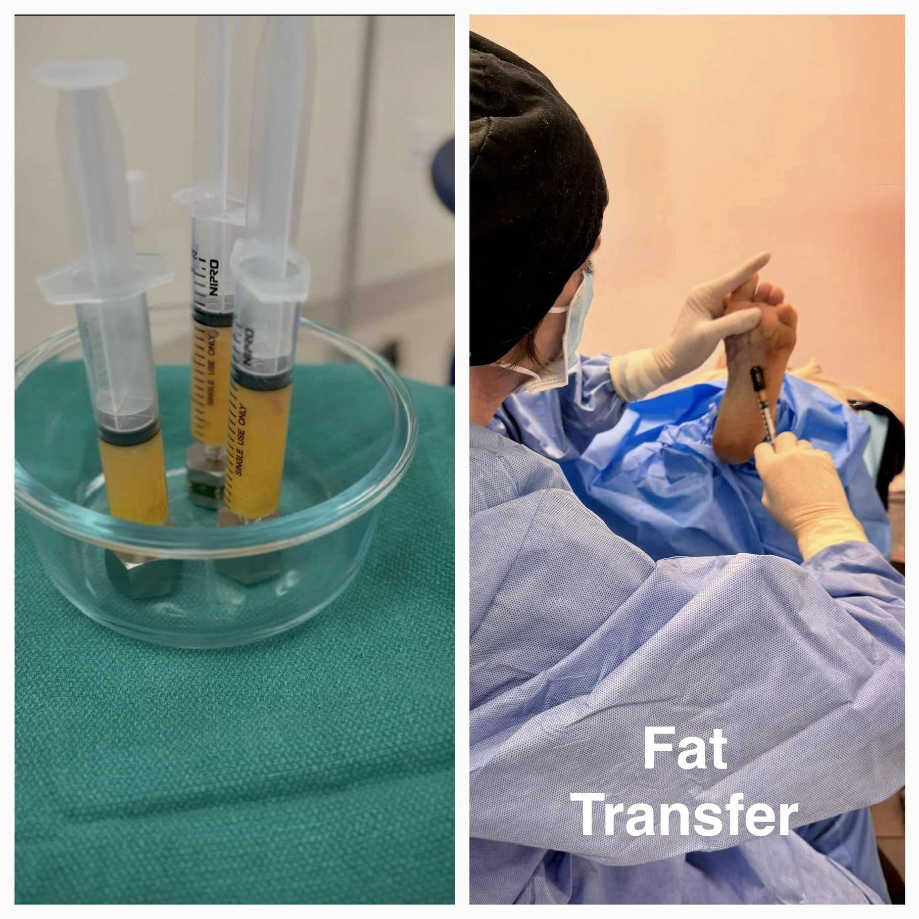 Syringes filled with adipose tissue and surgeon injecting donor fat into the sole of a foot.