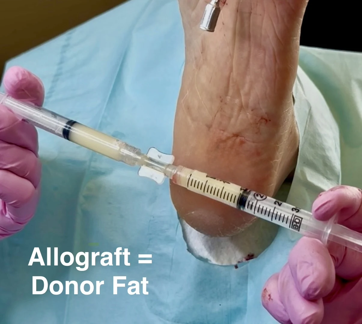 Medical practitioner preparing syringes with allograft donor fat for foot fat pad grafting procedure.